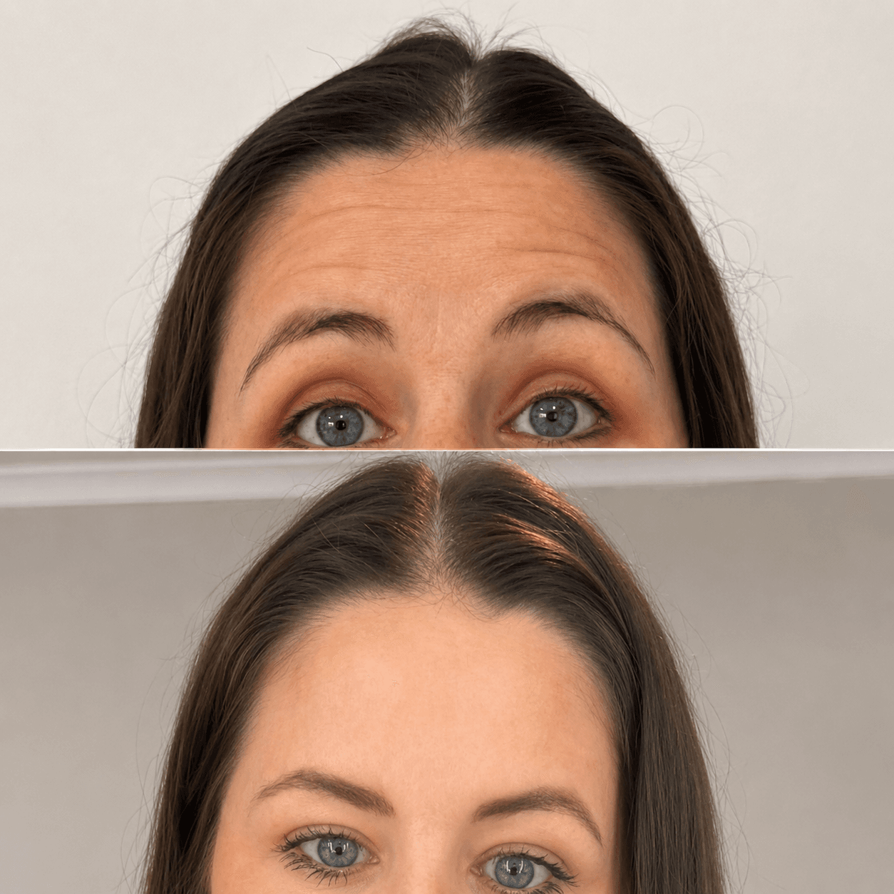 Caso Clínico - Aplicação de Botox